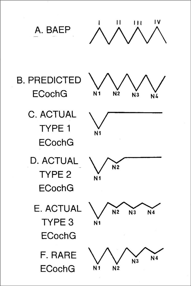 Traces A and B display the predicted relationship between the BAEP and the ECochG. In these, each positive BAEP wavelet has a negative counterpart in the ECochG and all the components in each waveform are approximately the same size as the initial one ( I or N1 ). Traces C, D, E and F demonstrate the main four varieties of the ECochG which are actually or routinely recorded. In all four                    examples, individual components are either missing or else attenuated when                  compared to hypothetical trace B. Note that these are artificial waveforms not                derived from any data and no amplitude or latency scale applies.