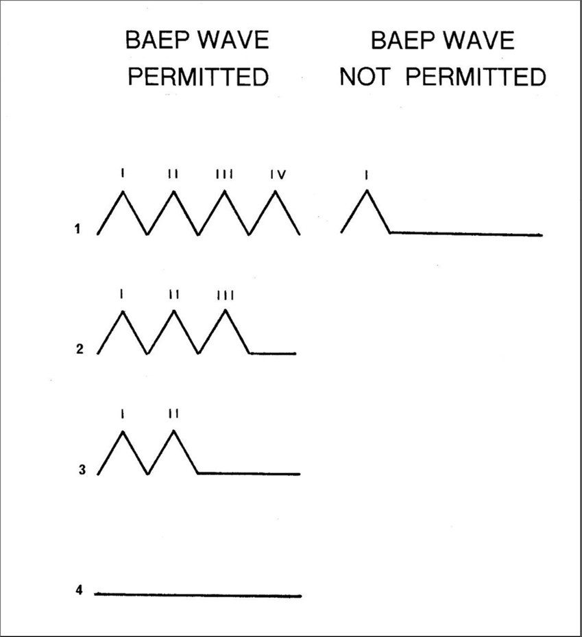 Schematic illustration of the four waveforms which are compatible with the new                 version of BAEP generation and the one which is not.