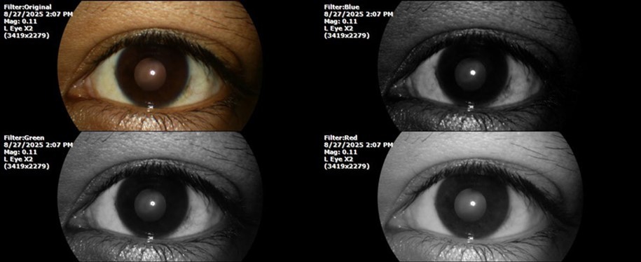 The mirror reflection of the healthy eye (L. E.) continues within normal limits.