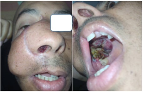 Clinical presentation of the patient objectifying the nasal and palatal jugal involvement.