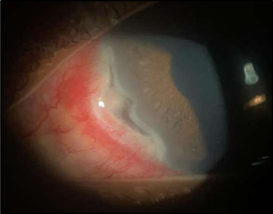 Left eye (OS), on presentation. Slit-lamp image: crescent-shaped peripheral corneal ulceration located nasally, with severe adjacent conjunctival injection, peripheral thinning, and stromal infiltration.