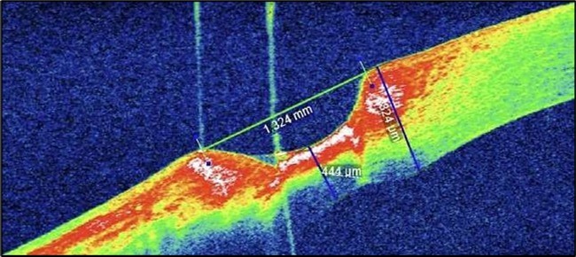 (At presentation): AS-OCT reveals a crescent-shaped peripheral corneal ulcer with marked stromal thinning of 380 µm in depth and complete loss of the overlying epithelium. The ulcer spans 1324 µm in width. The ulcer base appears concave with hyperreflective stromal margins, and a distinct overhanging edge is visible at the inner margin.