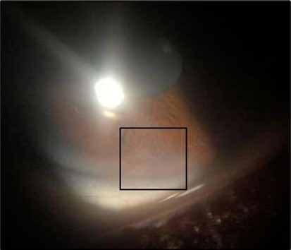 Right eye (OD), Slit-lamp photo with a faint peripheral, inferonasal, small non-significant scar vascularization.