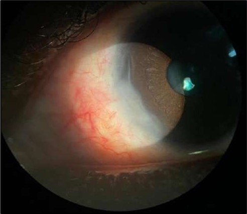 OS. Slit-lamp photograph showing a partially quiet ocular surface two weeks following surgical excision of adjacent perilimbal conjunctiva.