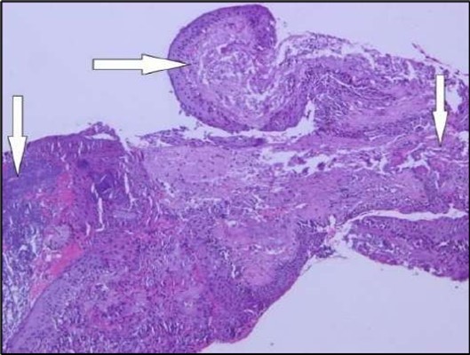 OS, Hematoxylin and eosin (H&E) stained section of the corneal specimen demonstrating full-thickness epithelial loss with underlying stromal necrosis.