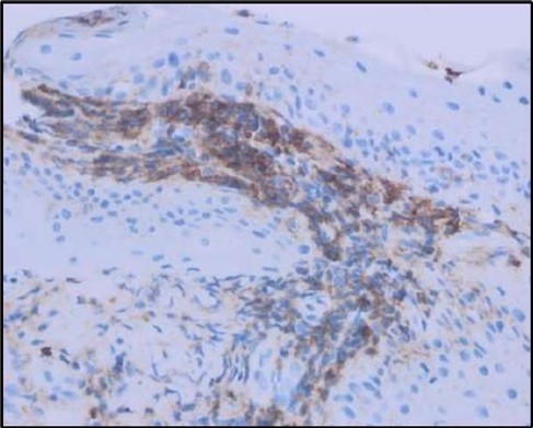 OS, Immunohistochemical stain using CD45 (leukocyte common antigen) demonstrating a dense population of lymphocytes stained brown