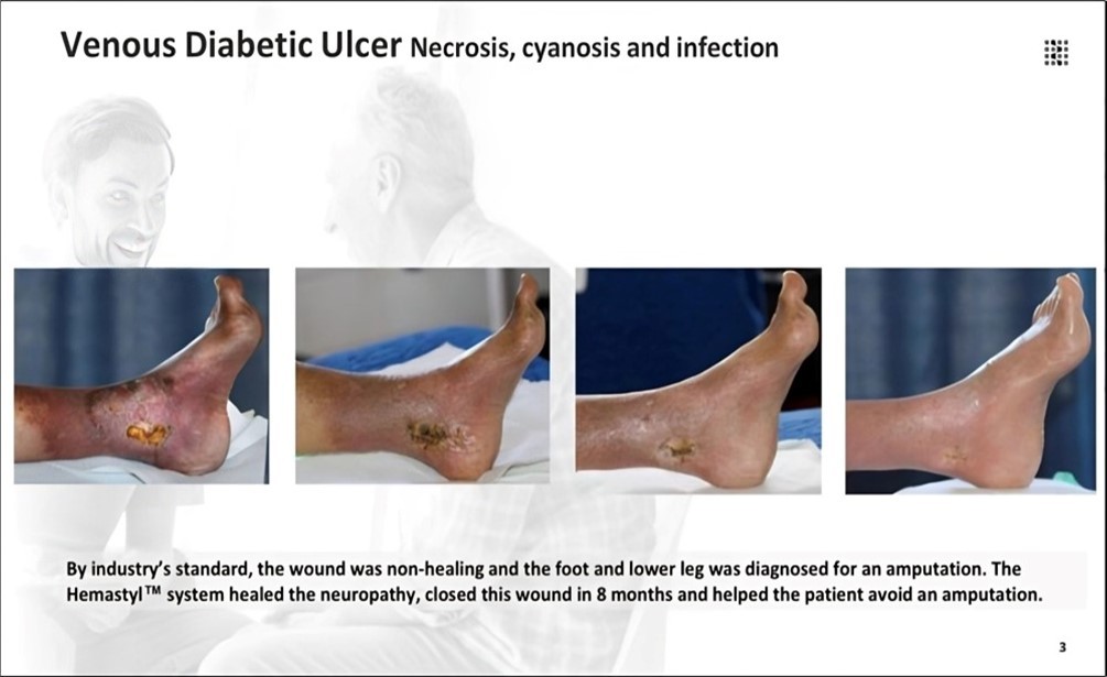 The lesion met clinical thresholds for non-healing and the patient was advised to undergo foot and lower-leg amputation. The Hemastyl™ System restored nerve function and led to full wound closure after 8 months, eliminating the need for amputation.