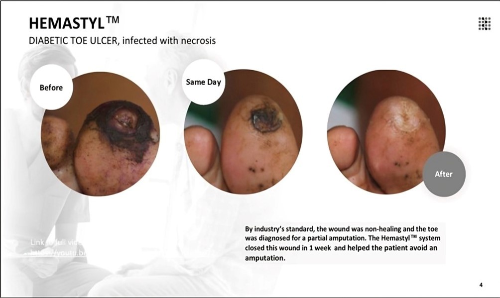 The wound was classified as non-healing according to standard clinical criteria, and the patient was indicated for partial toe amputation. With the Hemastyl™ System, the wound successfully closed in 4 months and the patient avoided amputation.